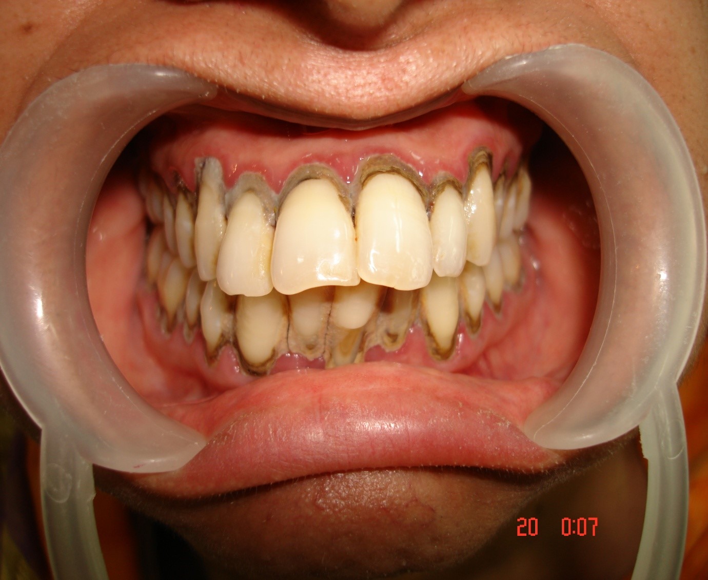 Dental implant specialist in Delhi