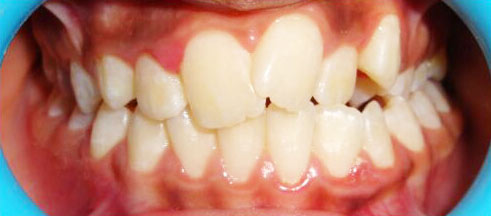 Braces for the teeth