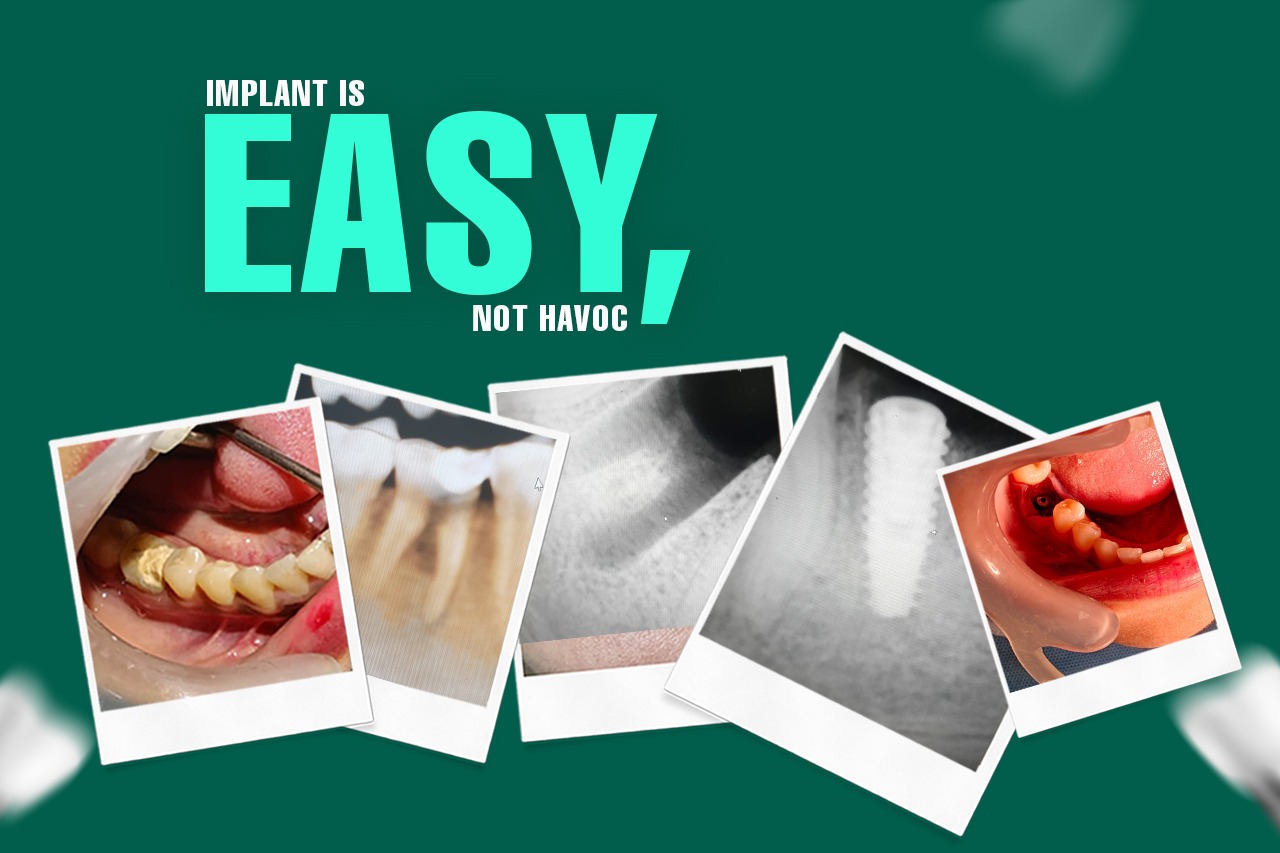 Same Day Dental Implants A Modern Solution to Missing Teeth?