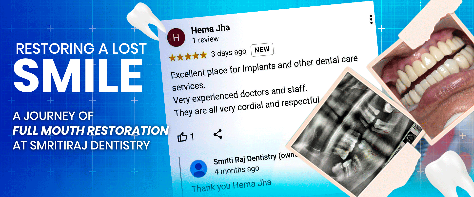Restoring-a-Lost-Smile