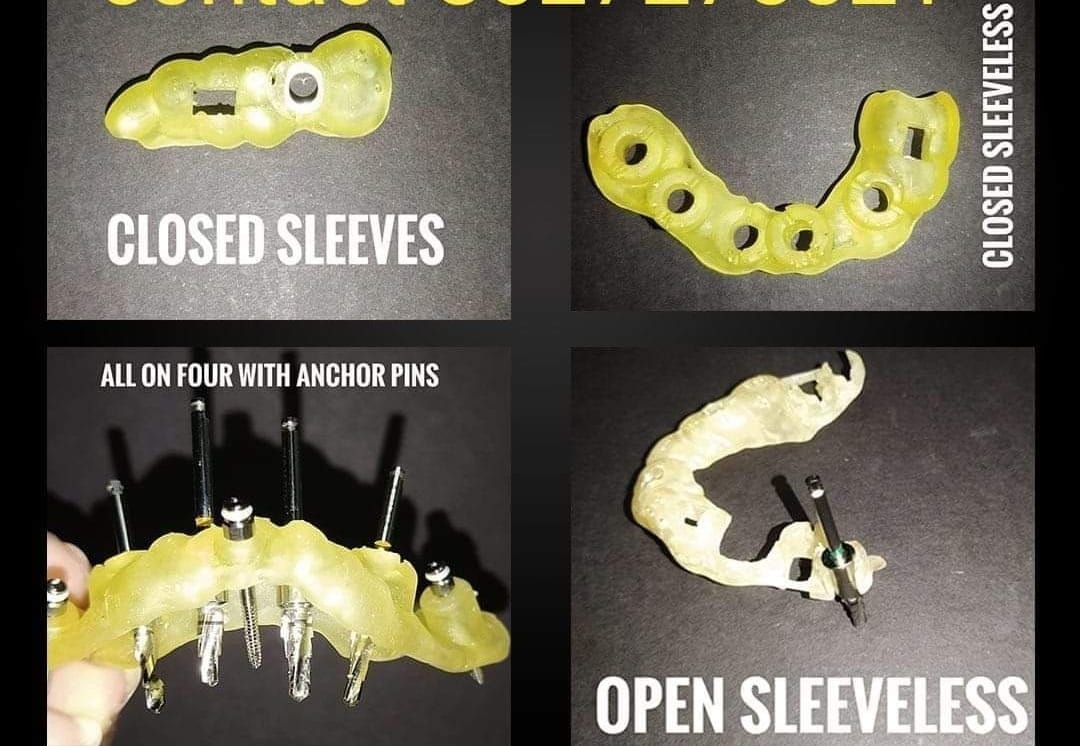 Dental Implant