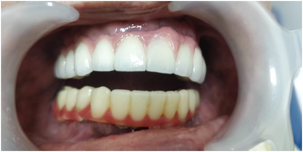 Zirconia bridge